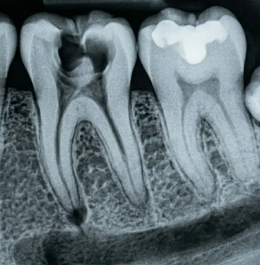 Intraoral X-ray
